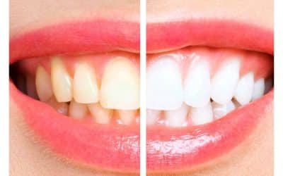 Détartrage et éclaircissement dentaire : quelle différence ?